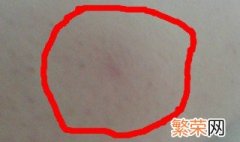 蚊子咬的包怎么解决 蚊子咬的包解决方法
